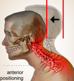 Anterior Positioning Injury Claim Defense for WFH IWs - Fraud Sniffr ...